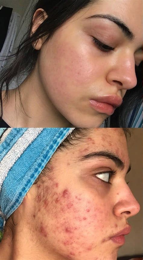 How to remove acne scars from face naturally how to get rid of pimples ...