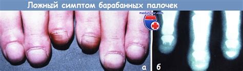 Причины изменения форм пальцев (акростеолиза)