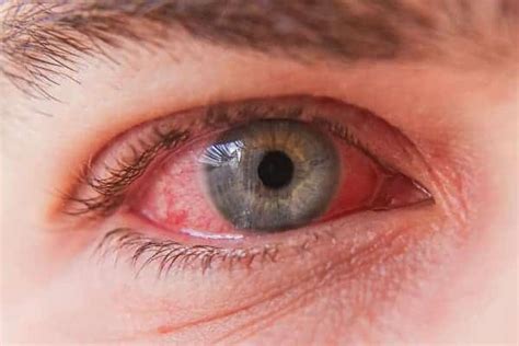Oeil rouge et douloureux - Dr Pierre-Maxime Lévêque