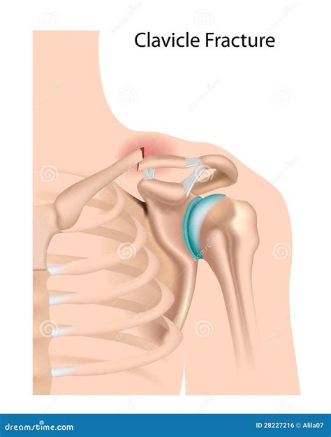 Clavicle fracture stock vector. Illustration of ligament - 28227216