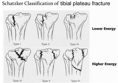 tibial plateau fracture  types symptoms diagnosis treatment