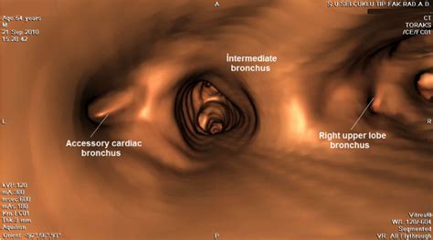 Virtual bronchoscopy views of accessory cardiac bronchus of 54-year-old ...