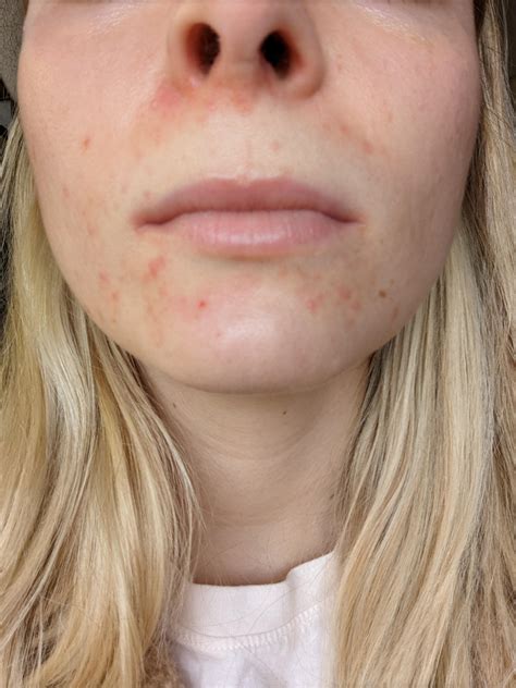 rash/ bumpy skin around nose and sides of mouth. See comments to follow