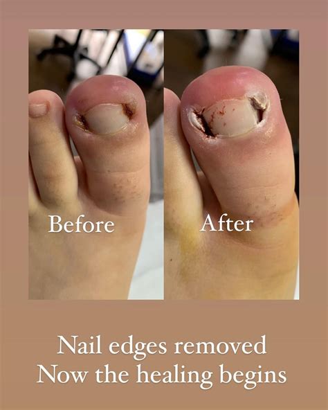 Painful ingrowing toe nails... - St Margarets Foot Clinic