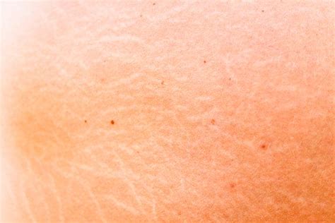 Understanding Orange Peel Skin: Causes and Solutions - Aesthetics Unique