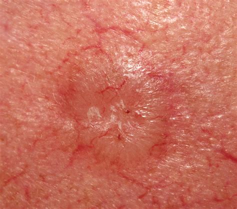 basal cell carcinoma doctorlansfordcom