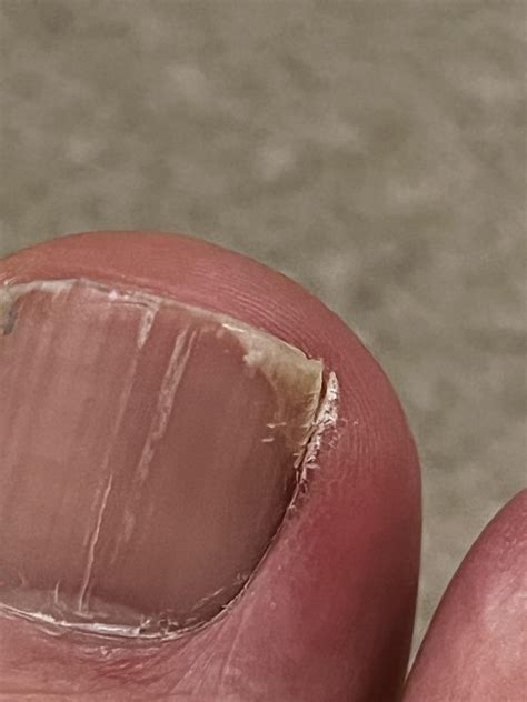How do I cut these corners : r/Ingrown_Toenails
