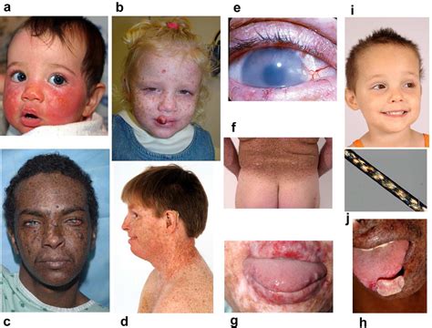 Shining a light on xeroderma pigmentosum. - Abstract - Europe PMC