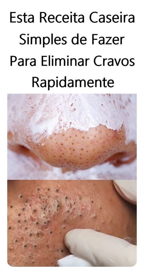 Como Remover Os Cravos - Como ACABAR Com Os CRAVOS Com APENAS 2 Ingredientes | Cravos e espinhas ...