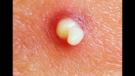 How To Pop A Pimple! (Pimples, Acne, Cyst Popped - Popping) - World's ...