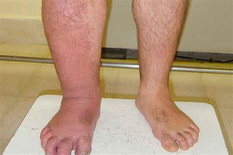 Linfedema - Clinica Hispana Woodforest