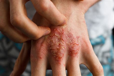 Common Skin Conditions | Dr Carol Adib | Brisbane Dermatologist