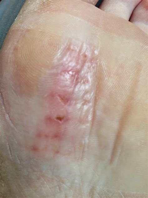 Taylor's Foot Story: 10 Days Post Infection and...More Antibiotics