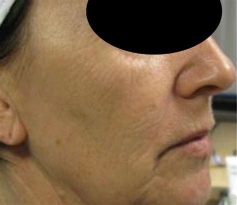 tixel treatment gone wrong 2