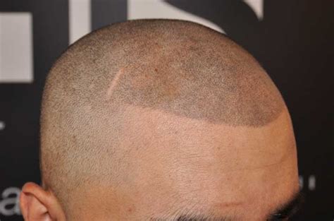 adding fake scars   scalp micropigmentation treatment  hair