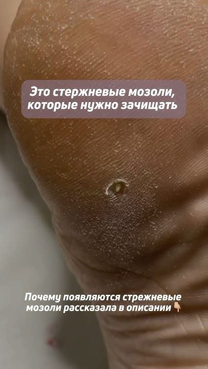 Почему появляются стержневые мозоли и как с ними бороться? Рассказала в ...