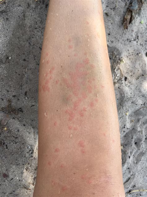 Skin Allergy After Beach at Robert Tate blog