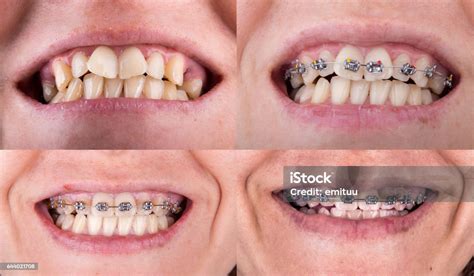 Antes E Depois Do Aparelho Dentário - Foto de Aparelho Dentário Antes E Depois e mais fotos de stock de Antes ...