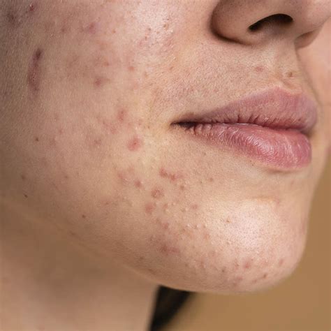 What Is Acne And How Does It Form? — Hope Della