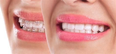 teeth whitening procedure Archives - medical