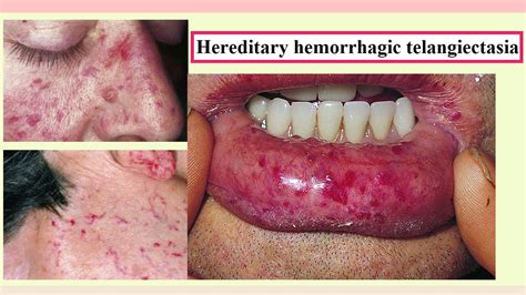 Hereditary Hemorrhagic Telangiectasia - Rememberology