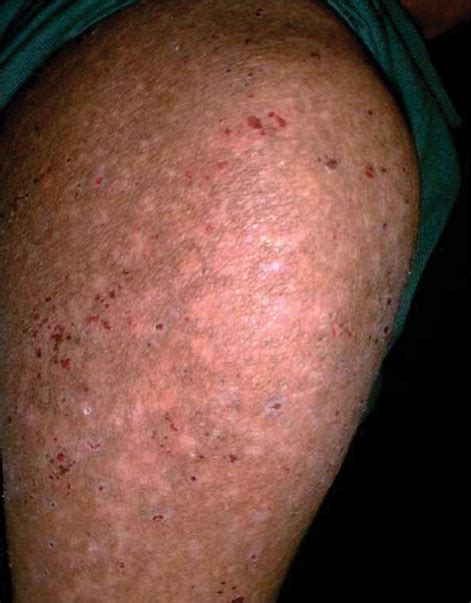 epidemic typhus  lancet infectious diseases