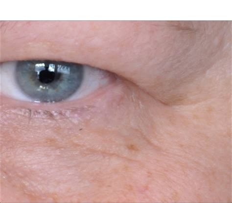 Before and After | Revision Skincare®