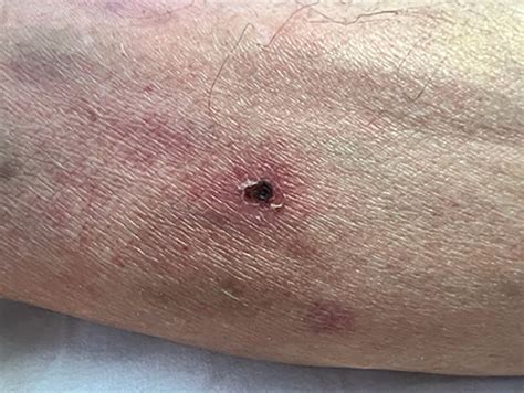 Scrub typhus: the clinical significance of the eschar | BMJ Case Reports