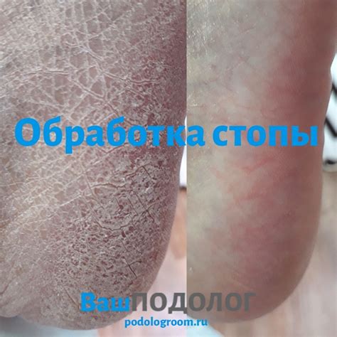ДО И ПОСЛЕ: ОБРАБОТКА СТОПЫ. ПРИЧИНЫ ГИПЕРКЕРАТОЗА Гиперкератоз ...