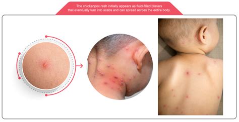 chickenpox  varicella vaccination frontier healthcare group