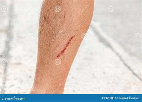Close Up Scar on Skin. the Wound Form Scabs on Leg. Man with Long Scab ...