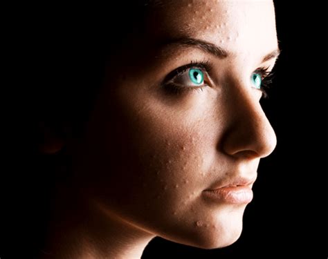Let's Test Your Acne Knowledge. - Aesthetic Skin & Anti-aging Authority
