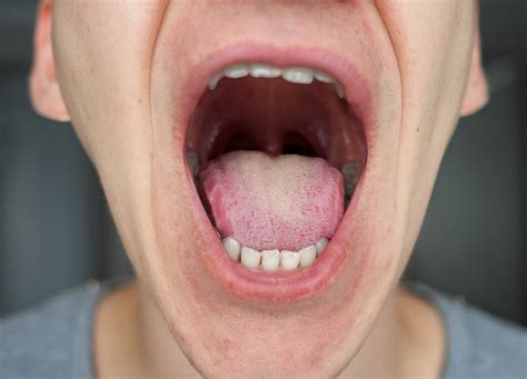 White Spots On Tonsils Why Do White Spots Appear On The Tonsils?