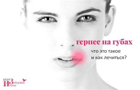 Герпес на губах. Как вылечить герпес на губах быстро