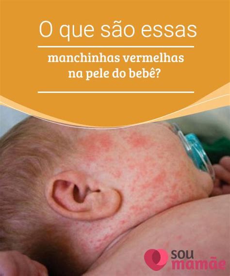 Bolas Vermelhas Na Pele Do Bebe - manchas vermelhas na pele do bebê - underlyingsolutions
