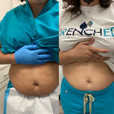 MESOTHERAPY/LIQUID LIPO – Drenched Wellness