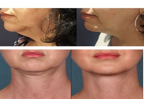 HIFU - FACE Lifting Treatment - Danai Wellness