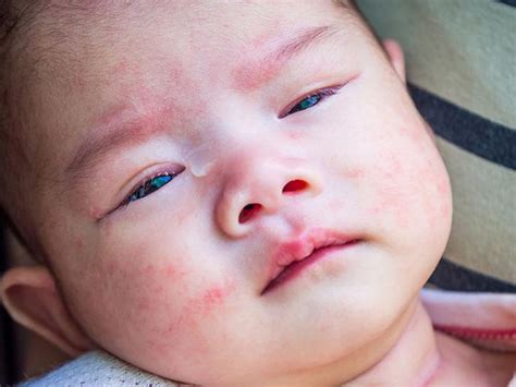 Symptoms And Pictures of Baby Allergic Reaction Rash