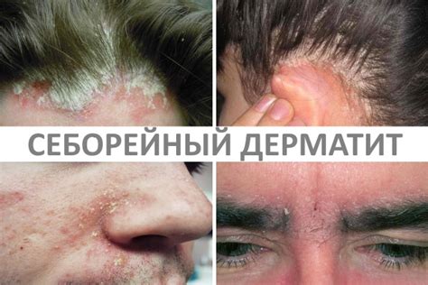 Себорейный дерматит: виды, симптомы, лечение и профилактика