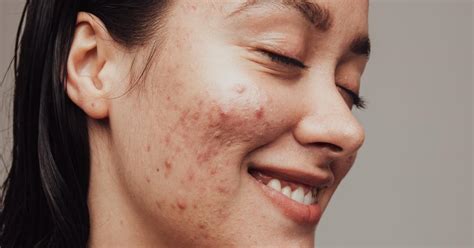 Дааврын батга – MIRUSKINCARE