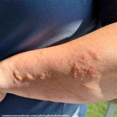 Stages Of Poison Ivy Rash - sippjawe