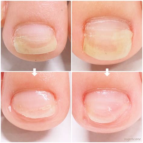 2重になる爪 | -- footcare salon sugarcane