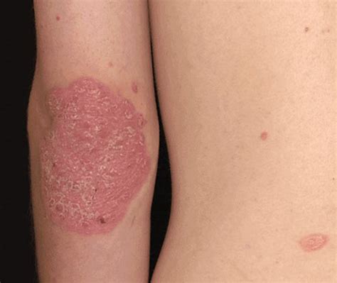 Frank H Netter Skin Disorders Psoriasis And Eczema Poster European Netter Poster Series 1e 5