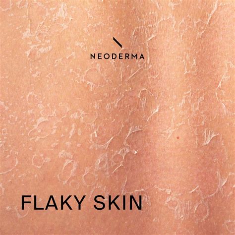 Flaky Skin After Waxing & Dry Flaky Skin Side of Nose | NEODERMA