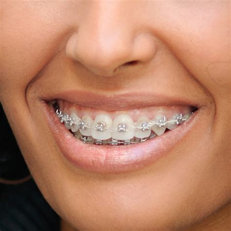 braces  adults cumming dental associates