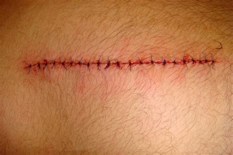 How to remove stitches safely at home | Medical stitches, Stitches medical, Stitch