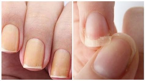 Unhas Quebradiças O Que Fazer - Unhas Quebradiças: O que é, e saiba o que fazer para evitar