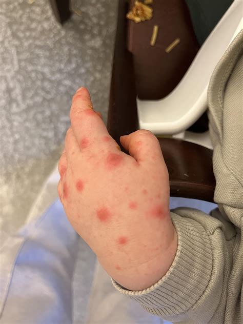 Two doctors couldn’t identify this rash : r/DermatologyQuestions