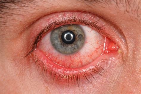 Chlamydial conjunctivitis vs. Gonococcal conjunctivitis Symptoms ...