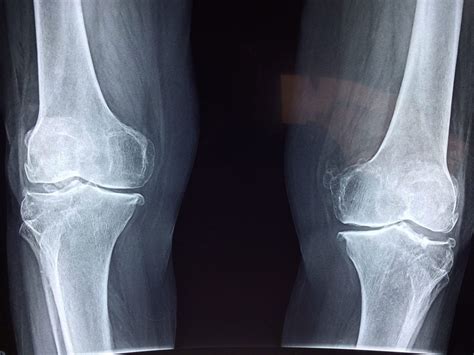 A New Hope for Rare Bone Disease - Patient Worthy